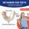 Custom Retainers for Teeth